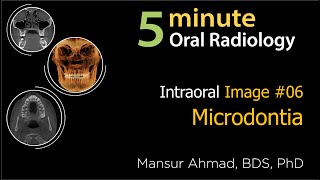 Microdontia Intraoral Radiographic Interpretation [upl. by Leirraj]