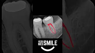 Reading a Periapical dental xray [upl. by Eveline]