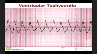 Taquicardias Ventriculares Dr David Castro Taller Electrocardiograma clase Zoom en vivo [upl. by Ivar]