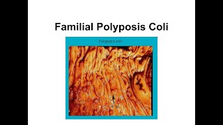 Familial Polyposis Coli [upl. by Ailed220]