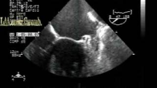 MS different aspectsleft atrial appendage thrombus TEE [upl. by Naivaf]