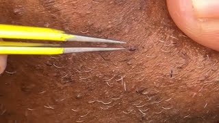 Tweezing chin hairs 25💛 [upl. by Eniamahs]