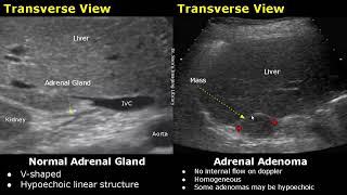 Adrenal Gland Ultrasound Normal Vs Abnormal Image Appearances  Cyst Adenoma Pheochromocytoma USG [upl. by Leinod]