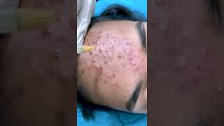 chemical peel treatment for acne  acne treatment  Skinaa Clinic viral shorts [upl. by Hgierb]