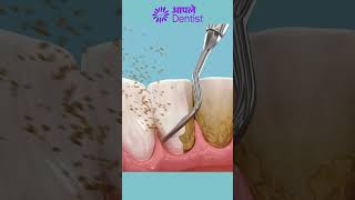 Teeth Cleaning With Ultrasonic Scaler [upl. by Eve502]