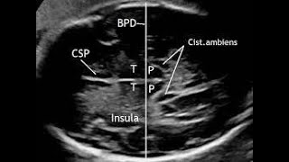 How to measure Biparietal diameter by Ultrasonography [upl. by Dahs582]