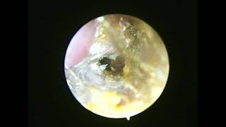 Grade 3 External Auditory canal Exostosis [upl. by Mian]