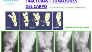 Dra Sonia Vidal Rodriguez Fractura y luxación del carpo e inestabilidades carpianas [upl. by Keele]