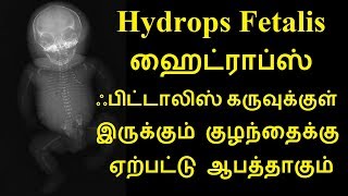 Hydrops Fetalis ஹைட்ராப்ஸ் ஃபிட்டாலிஸ் கருவுக்குள் இருக்கும் குழந்தைக்கு ஏற்பட்டு ஆபத்தாகும் [upl. by Eirased]