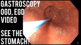 Gastroscopy  OGD  See inside the stomach [upl. by Chancellor]