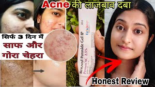 Benzoyl Peroxide Gel Honest Review  Benzoyl peroxide gel 25 Pernex  Benzoyl peroxide for acne [upl. by Nairadal]