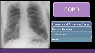 Chest Xray with Black lung field COPD Pneumothorax amp Bullae cxr radiology [upl. by Royo]