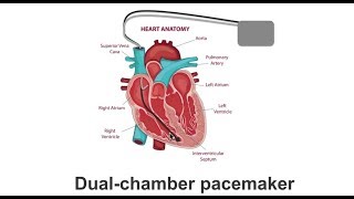 Pacemakers amp cardioinhibitory syncope [upl. by Atival]