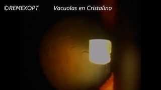 REMEXOPT Vacuolas en Cristalino [upl. by Derreg]