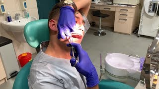 Self Extraction Wisdom Tooth 18 [upl. by Uah]