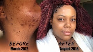 Clearing Dark Spots amp Hyperpigmentation  Updated Skincare Routine [upl. by Constant]