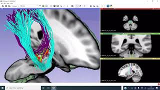 Sensory and motor pathways and lacunar infarcts using diffusion MRI data [upl. by Duke]