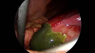 Laparoscopic Cholecystectomy in Gangrenous Gall Bladder [upl. by Kingsly]