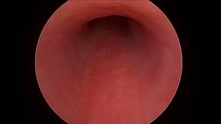 Isolated Grade IV Glottic stenosisposttraumatic [upl. by Eelyr209]