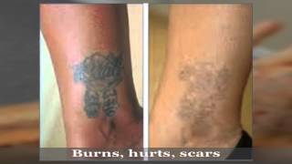 Tattoo removal Gone Wrong laser Treatment [upl. by Fairfield]