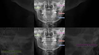 The xray of the mandible AP اشعة سينية للفك السفلي [upl. by Lough]