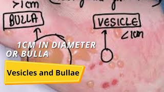 Vesicles and Bullae [upl. by Heiskell]