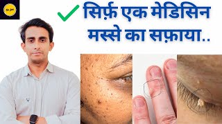 Best Medicine for warts  चेहरे के मस्सेगर्दन के मस्से DrJamil Ahmed Shah [upl. by Ahseinad153]