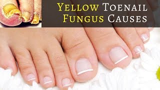 What Causes Yellow Toenail Fungus WARNING Find Out What Causes Yellow Toenail Fungus [upl. by Brietta]