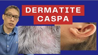 Livrese da DERMATITE SEBORREICA ou CASPA  Entenda as causas e tratamento da vermelhidão de pele [upl. by Nonad]