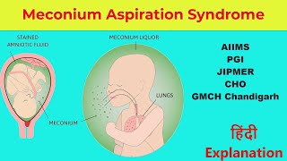 Meconium Aspiration Syndrome  Hindi lecture by Nirmla Kumari  Nursinginnovationhindi [upl. by Osber977]