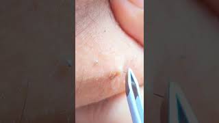 Plucking Chin Hair  Female Beard  PCOS Hair satisfying [upl. by Yanttirb]