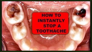 INSTANT TOOTHACHE RELIEF NATURAL TOOTHACHE REMEDIES 100  EFFECTIVE Khichi Beauty [upl. by Emia]