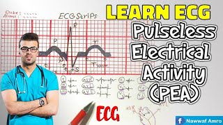 الايقاع الكاذب Learn ECG Pulseless Electrical Activity PEA [upl. by Lladnor]