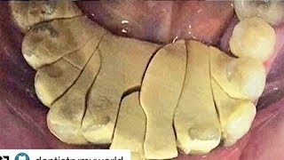 Dental Plaque and Worst Tonsil Stones [upl. by Christabel]