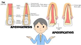 Apexogenesis and Apexification Mastering Endodontic Procedures as a Dental Student [upl. by Richlad]