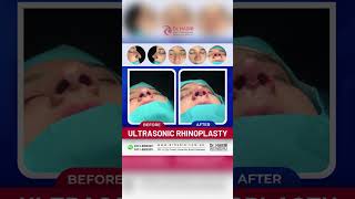 Transformative Rhinoplasty Before and After  Real Results and Patient Journey [upl. by Oberon]