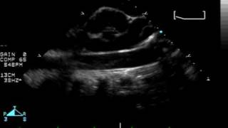 Descending Thoracic Aorta [upl. by Alya]