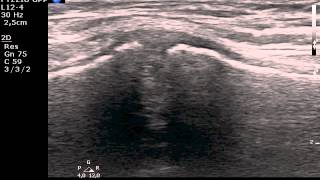 Manubriosternal joint MSKUS ultrasound [upl. by Assiluj539]