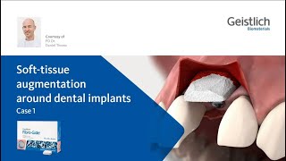 PD Dr Daniel Thoma SoftTissue augmentation around dental implants [upl. by Annawad385]