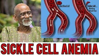 Dr Sebi  Natural Remedy For Sickle Cell Anemia [upl. by Rekcut]