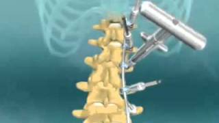 Scoliosis Spinal Fusion Animation [upl. by Zsuedat]