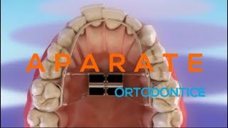 Aparate si proceduri ortodontice [upl. by Eem]