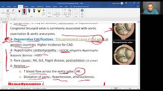 Aortic stenosis 2025 [upl. by Akeemat]