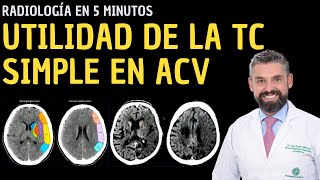 Radiología en 5 minutos Utilidad de la tomografía computarizada simple en ACV [upl. by June696]