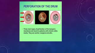 Tympanic membrane perforation [upl. by Lajet]