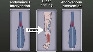 Treating Venous Leg Ulcers [upl. by Marder]