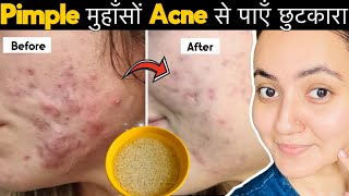 सिर्फ 7 दिनों में PIMPLESमुंहासे दागधब्बे Acne Marks को जड़ से खत्म करेंपाए बेदाग़ Glowing Skin💕 [upl. by Flosi]