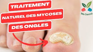 Traitement naturel des mycose  mycose pied  mycose ongle pied  mycose ongle main et les autres [upl. by Louanne]