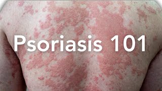 EVERYTHING to Know About Psoriasis  Dermatologist Explains [upl. by Oinoitna717]