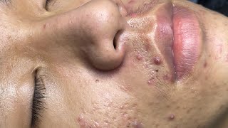 ACNE TREATMENT VU QUYNH MI  Blackheads Of Tweens 2024 EX [upl. by Anilosi]